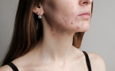 The Best Treatments For Acne Prone Skin
